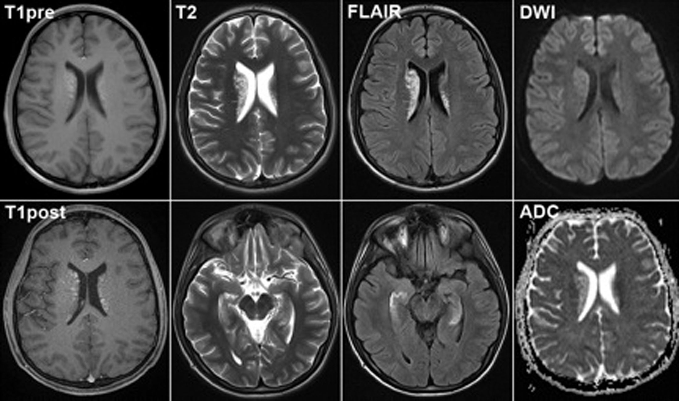 Послойный снимок головного мозга выполненный на аппарате МРТ